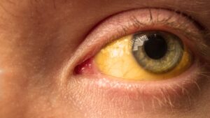 5 أسباب لاصفرار العين وعلاجها وطرق الوقاية منه