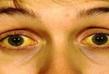 5أسباب لاصفرار العين وعلاجها وطرق الوقاية منه