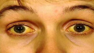 5أسباب لاصفرار العين وعلاجها وطرق الوقاية منه