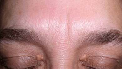 علاج ترهل جفن العين العلوي ومدي جدوي عمليات الشد