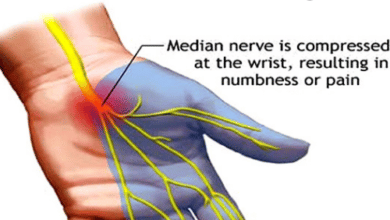 5 نقاط حول علاج انسداد عصب اليد وجراحة تسليك الأعصاب