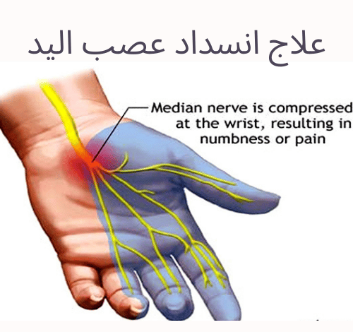 5 نقاط حول علاج انسداد عصب اليد وجراحة تسليك الأعصاب