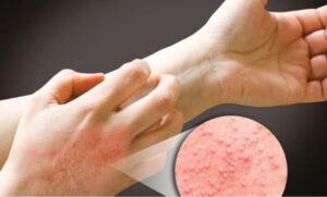 طرق علاج حساسية الجلد بأنواعها ال 4 الشهيرة والوقاية منها